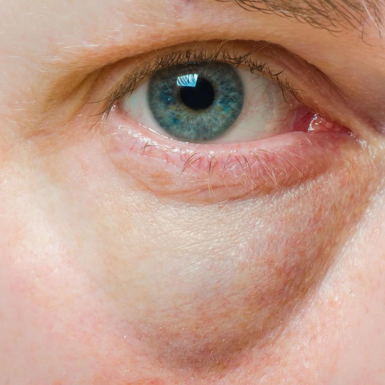 cafe para bolsas en los ojos - Cómo eliminar las bolsas de los ojos rápido