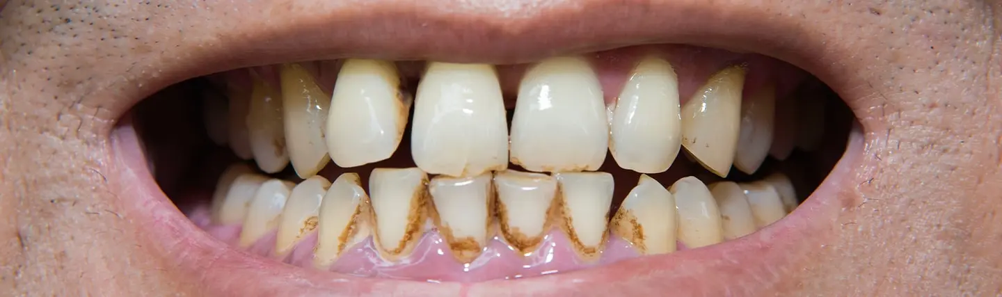 manchas de cafe en dientes - Cómo quitar las manchas de café y tabaco de los dientes