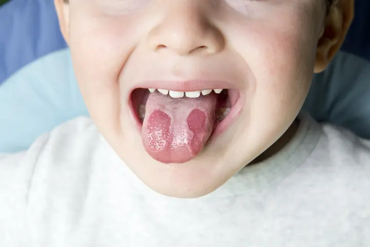 quemadura garganta por café - Cómo saber si te has quemado la garganta