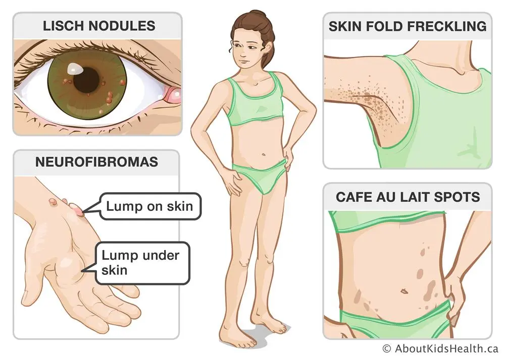 cafe au lait spots neurofibromatosis - Cuál es el patrón Histologico caracteristico de los tumores de neurofibromatosis 1