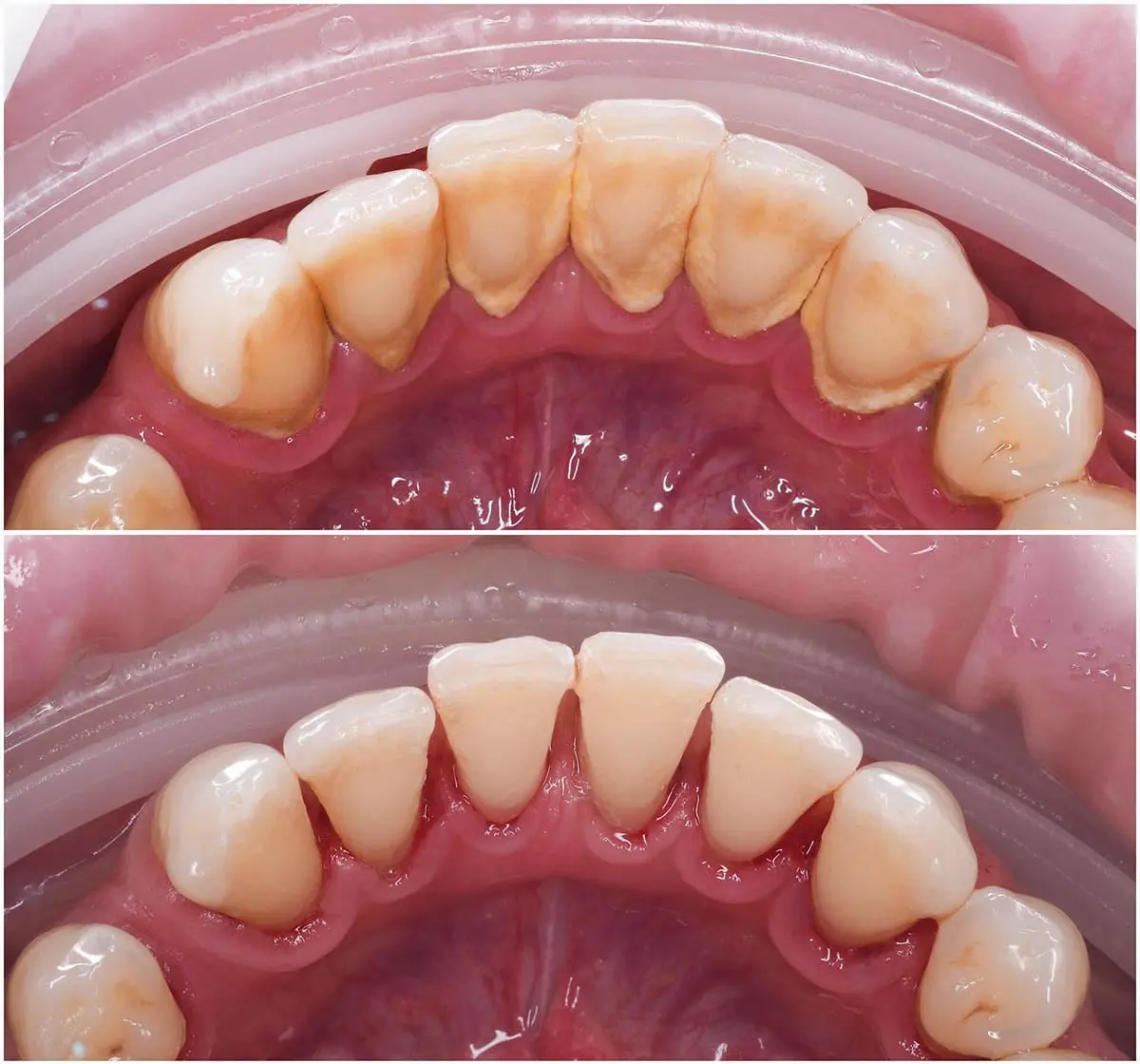 se puede tomar cafe despues de una limpieza dental - Cuándo puedo tomar café después de una limpieza dental