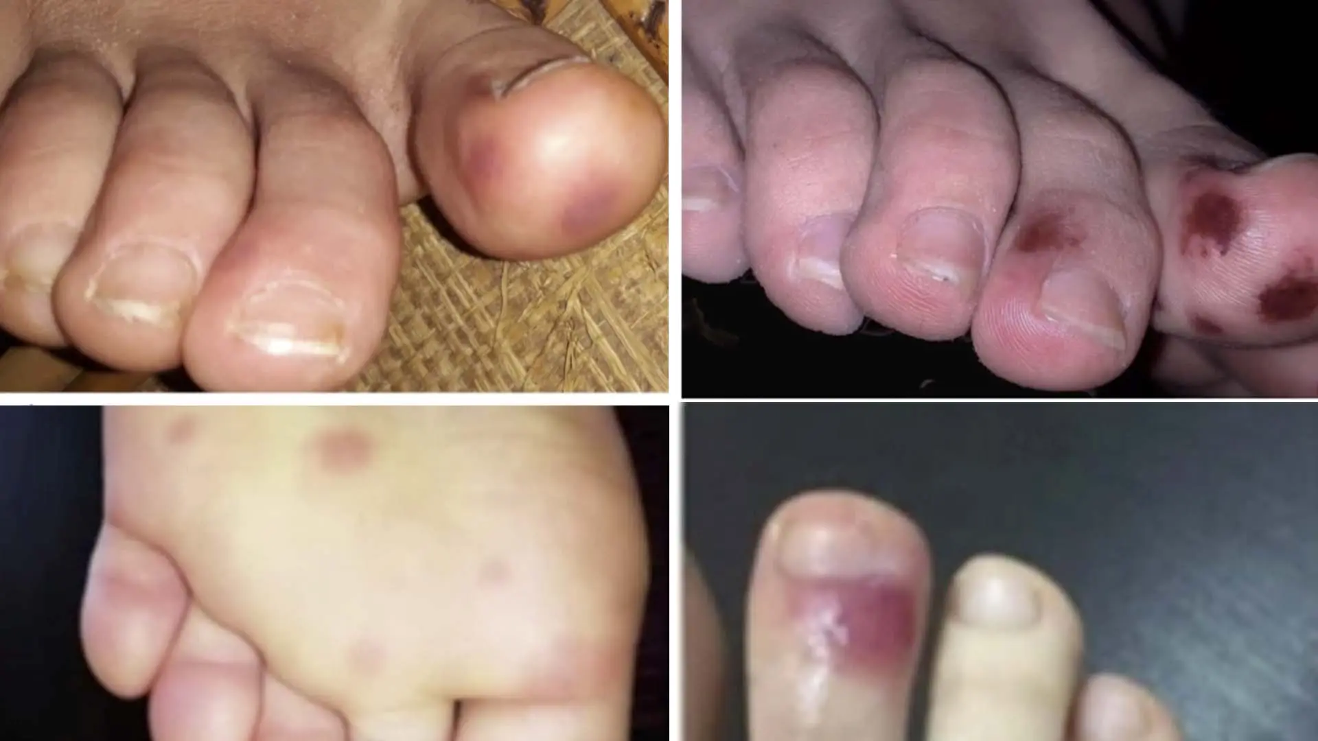 Manchas en los dedos de los pies color café: ¿qué son y cómo tratarlas? - Por qué tengo manchas en los dedos de los pies manchas en los dedos de los pies color café - Por qué tengo manchas en los dedos de los pies