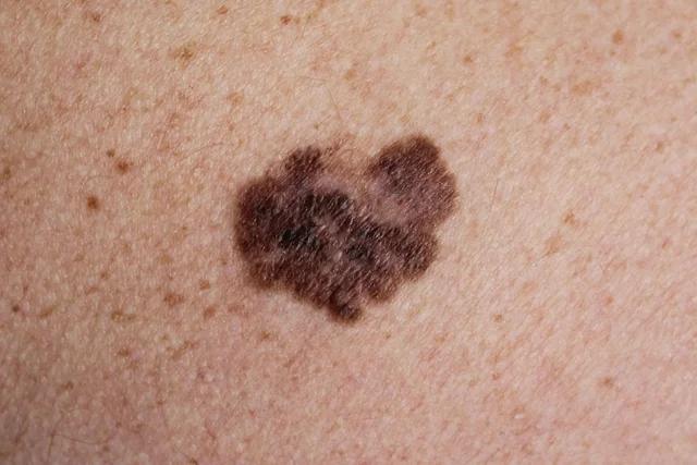 Manchas en el antebrazo color café: causas y tratamientos - Qué es bueno para las manchas cafes en los brazos manchas en el antebrazo color cafe - Qué es bueno para las manchas cafes en los brazos