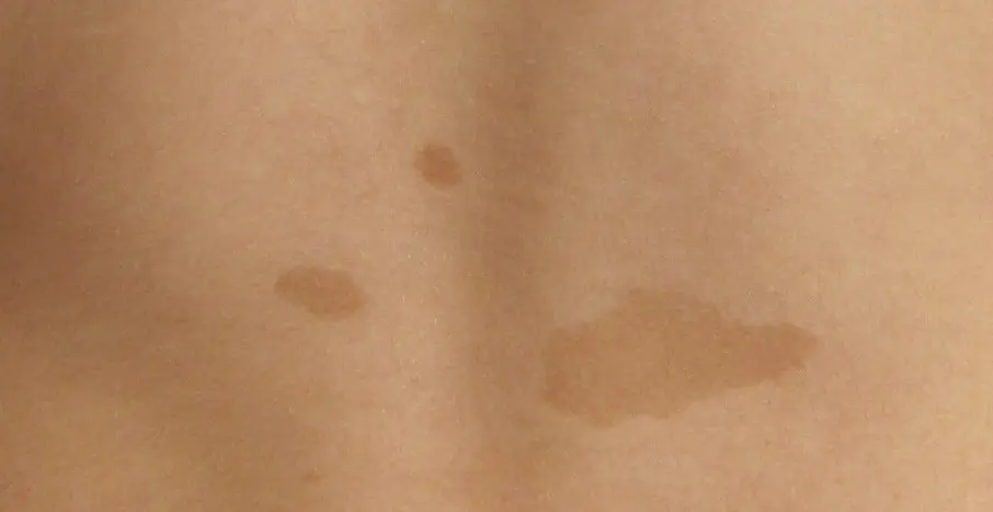 cafe manchas en la piel - Qué es bueno para quitar las manchas cafés de la piel