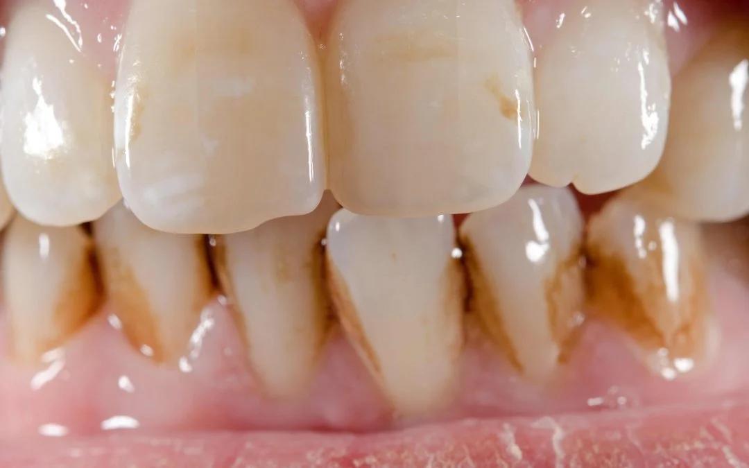 Café y los dientes: ¿Qué mancha más, el té o el café? - Qué mancha más los dientes el té o el café cafe y los dientes - Qué mancha más los dientes el té o el café