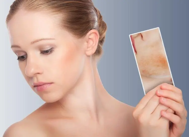 Dermatitis por café: causas, síntomas y tratamientos - Que no se debe comer cuando se tiene dermatitis atópica dermatitis por café - Que no se debe comer cuando se tiene dermatitis atópica
