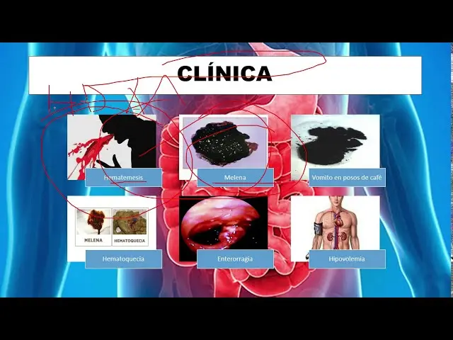 hematemesis posos de cafe - Qué produce la hematemesis