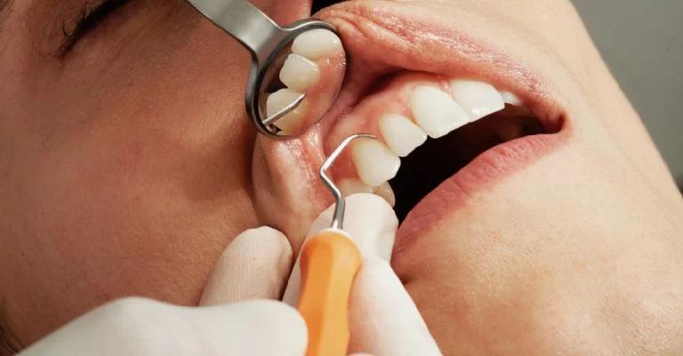 se puede tomar cafe despues de una limpieza dental - Qué puedo comer después de una limpieza profunda de dientes