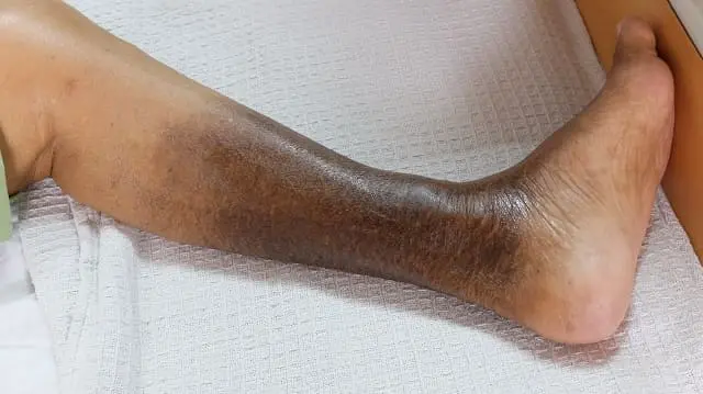 Manchas color café en los tobillos: causas, tratamientos y prevención - Qué significa manchas marrones en los tobillos manchas color cafe en los tobillos - Qué significa manchas marrones en los tobillos