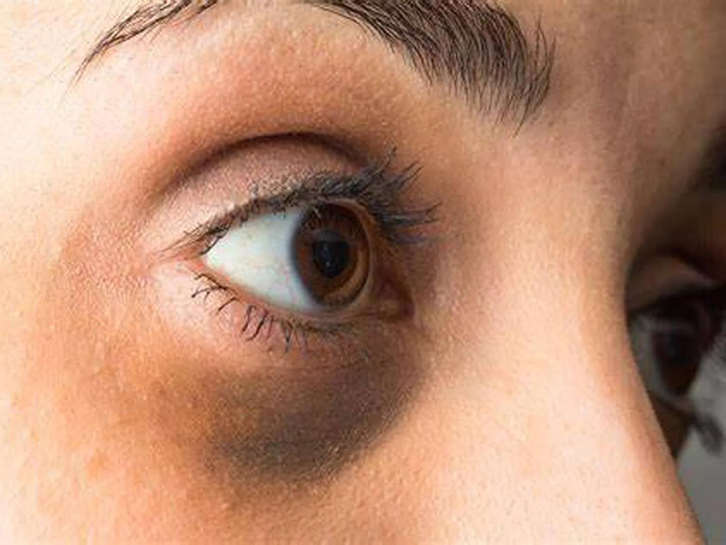 manchas café alrededor de los ojos - Qué significan las manchas oscuras alrededor de los ojos
